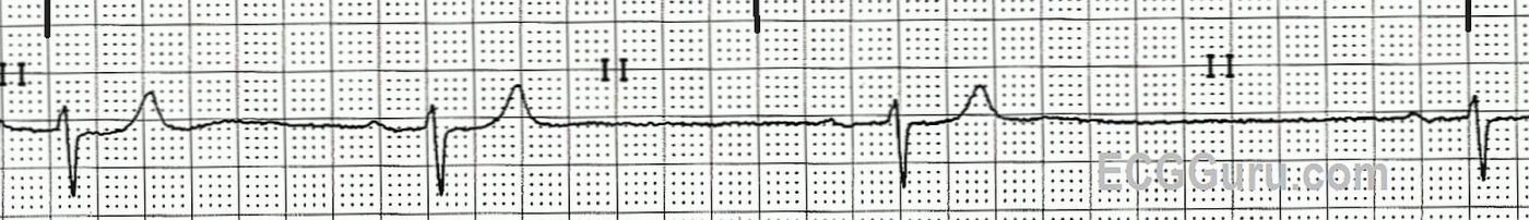 Ecg Basics Sinus Bradycardia With First Degree Av Block Ecg Guru